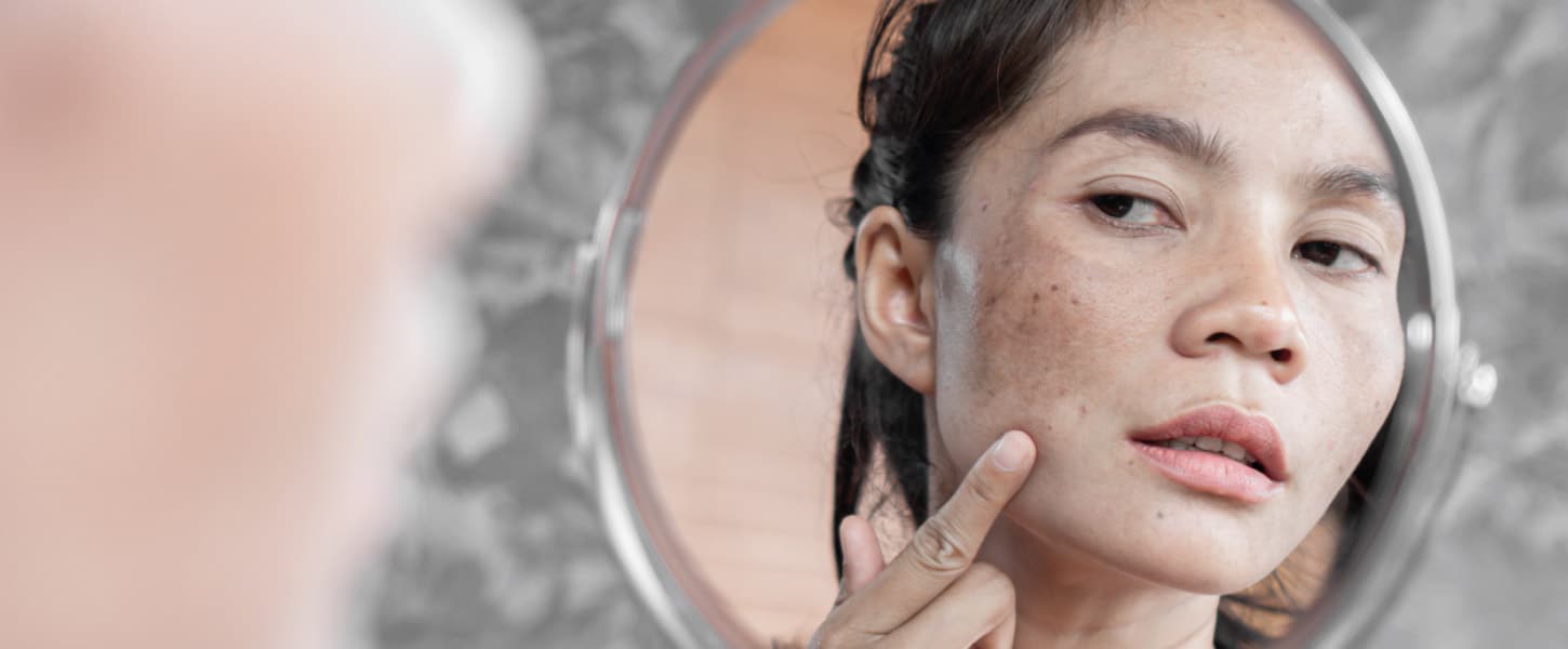 Conheça os 4 tipos mais comuns de manchas na face!
