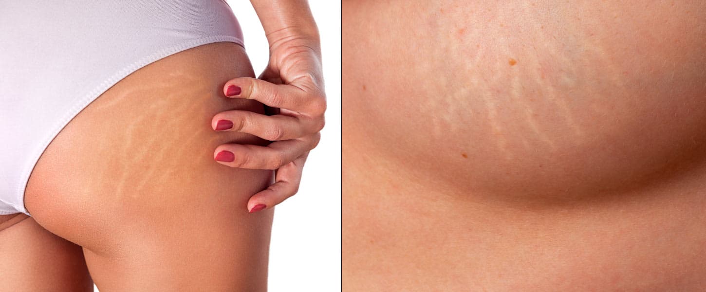 O uso do peeling químico no tratamento de manchas, rugas e cicatrizes. Estrias.