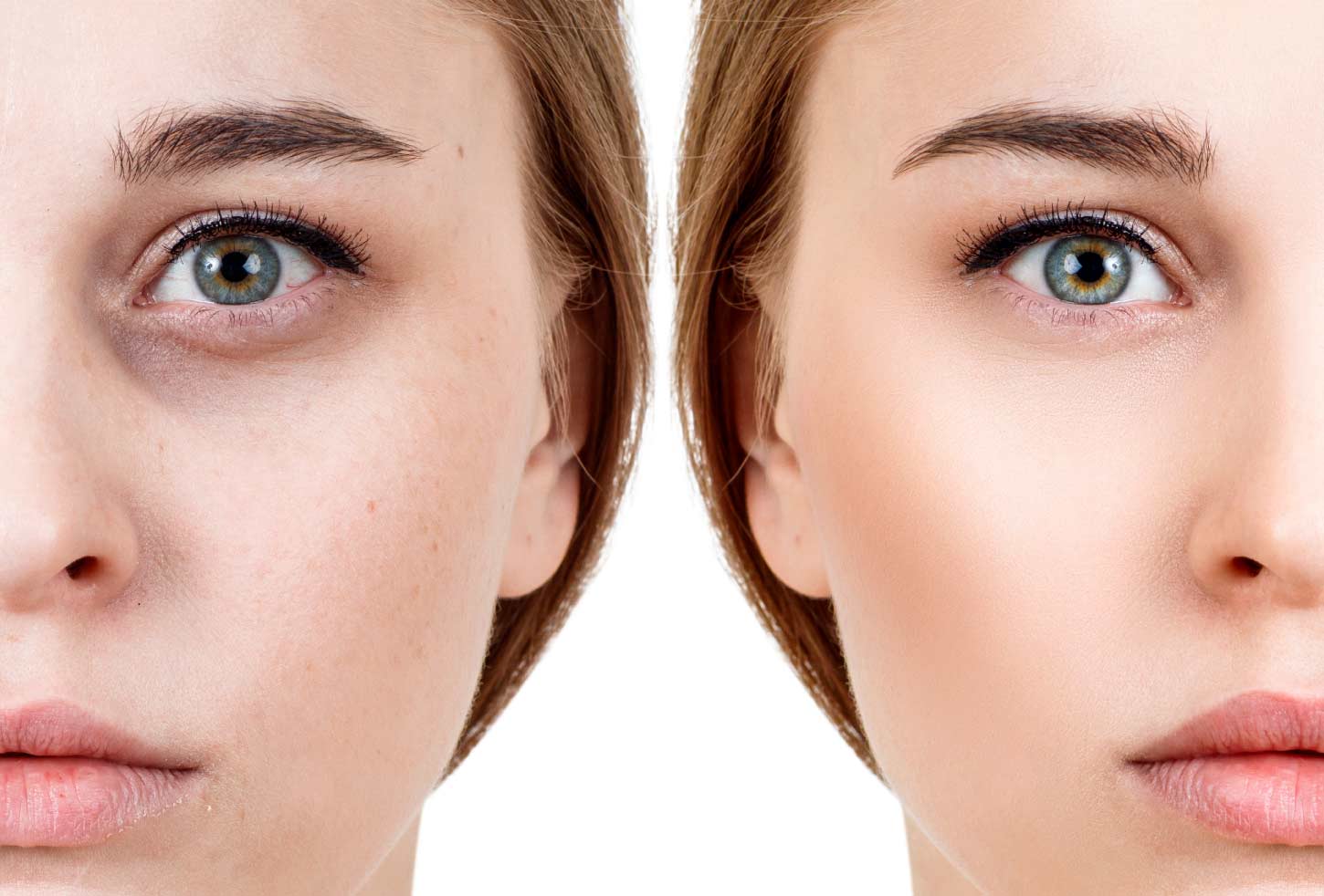 O uso do peeling químico no tratamento de manchas, rugas e cicatrizes. Olheiras.