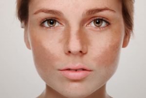 O uso do peeling químico no tratamento de manchas, rugas e cicatrizes. Melasma.