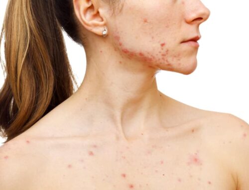 O pós-acne: saiba como se livrar das manchas e cicatrizes