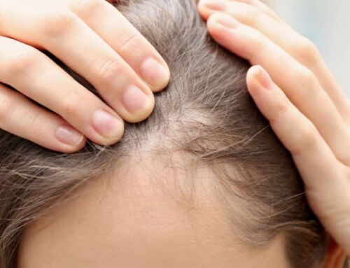 Causas da alopecia e como tratar