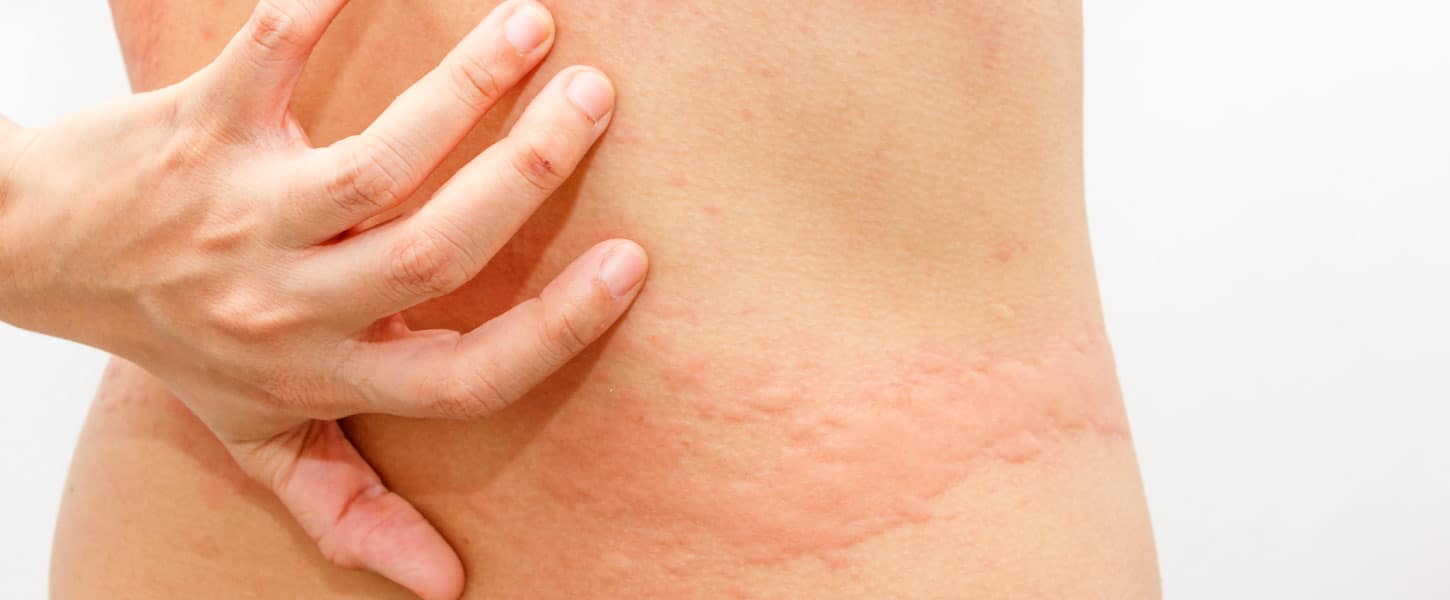 Conheça os diferentes tipos de dermatite